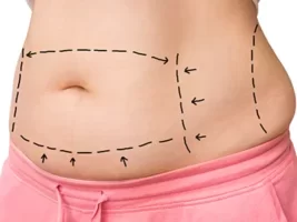 abdominoplasty